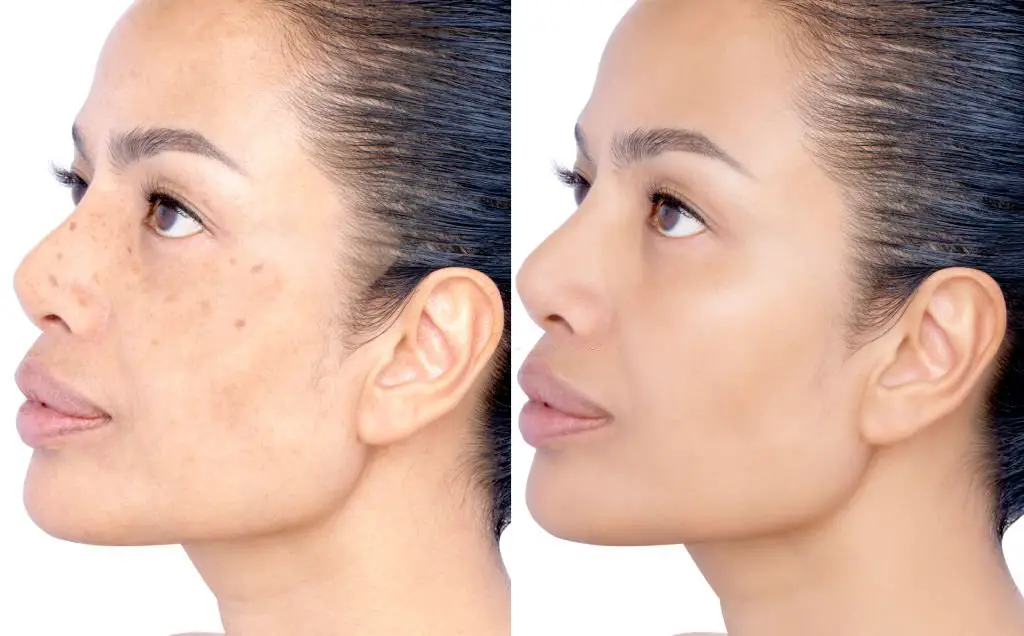 Dark Spot Cuticura Before and After