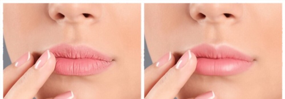 before and after lips