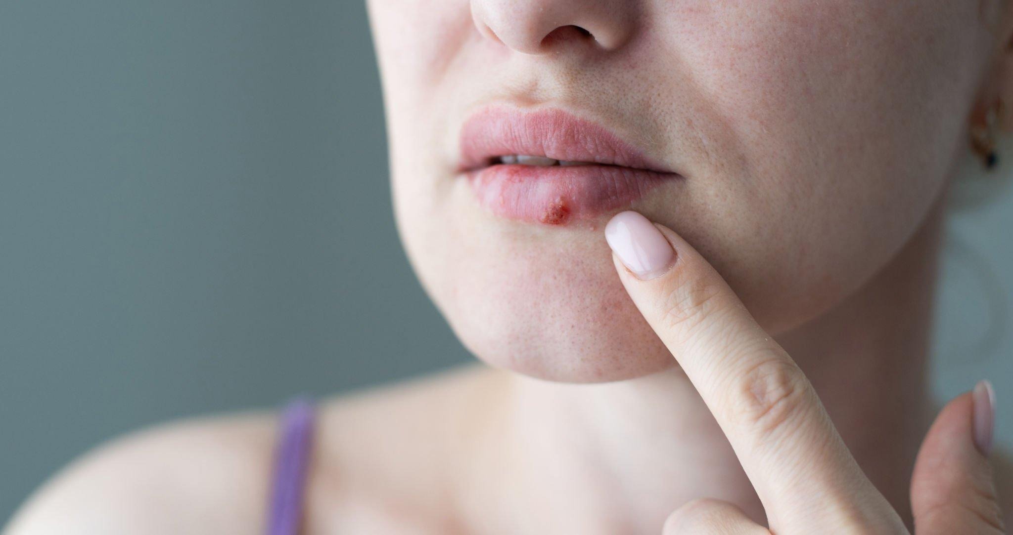 Are Hydrocolloid Patches Good for Cold Sores