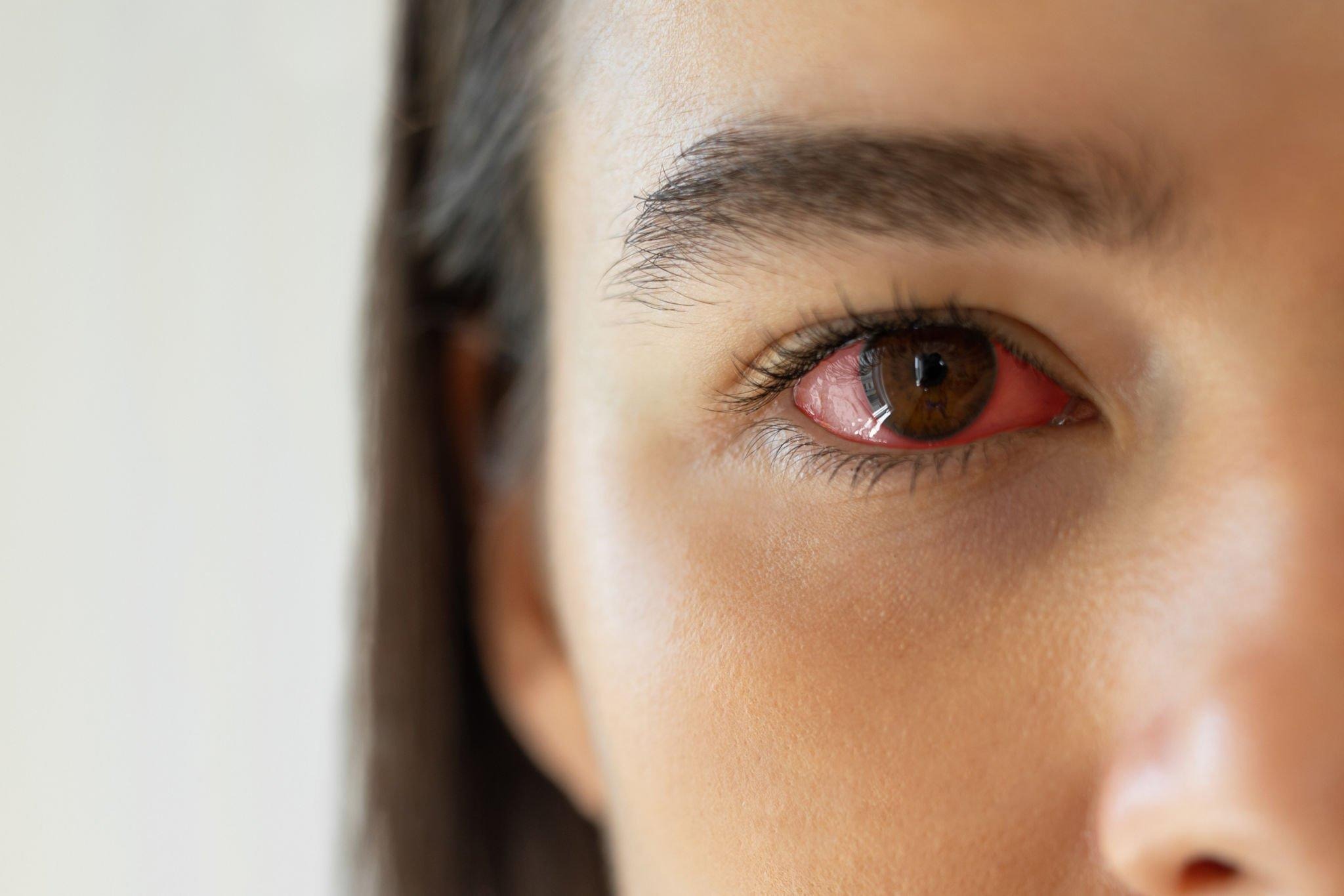 How to Treat Reaction to Eye Cream